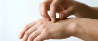 Close-up of a person applying white cream or lotion to their arm skin for skincare, moisturizing, or dermatological treatment purposes.