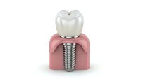 Dental implant cross-section showing titanium screw in jawbone with ceramic crown on white background for medical education and dentistry presentations.