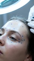 Professional cosmetic surgeon marking injection points on female patient face for botox treatment in modern medical clinic.