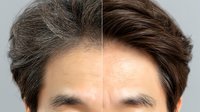 Before and after comparison of hair restoration treatment showing dramatic improvement from thinning gray hair to fuller, darker brown hair.