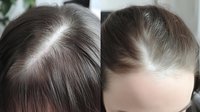 Close-up comparison of female scalp showing hair thinning and regrowth results, demonstrating effectiveness of hair restoration treatment.