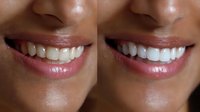 Before and after comparison of teeth whitening treatment showing dramatic improvement in dental aesthetics, close-up view of natural smile with healthy gums.