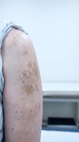 Close-up of arm showing age spots and freckles on mature skin, dermatology and skincare concept for medical education and beauty treatments.