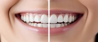Comparison of teeth whitening results showing before and after effect with bright white smile and healthy teeth against pink lips and smooth skin.