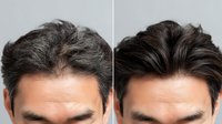 Before and after comparison of male hair restoration treatment showing improved hairline and fuller appearance for men experiencing hair loss.