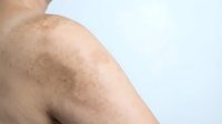 Close-up of human shoulder showing natural skin texture with freckles and age spots on clean white background for dermatology and skincare concepts.