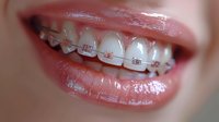 Close up view of white ceramic dental braces on teeth showing orthodontic treatment with metal brackets and wire against pink glossy lips and healthy smile.