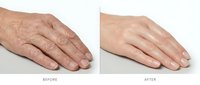 Before and after comparison showing hand rejuvenation treatment results with smoother skin texture and reduced age spots on white background.