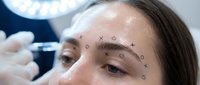 Young woman receiving cosmetic facial procedure with marked injection points for anti-aging treatment in medical clinic setting.