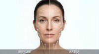 Young woman face showing cosmetic surgery transformation with marked guidelines for facial contouring and rejuvenation procedures on white background.