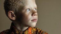 Young African boy with albinism in traditional colorful clothing looking upward with hope and determination against neutral background.