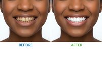 African American woman teeth whitening before after comparison showing dental treatment results and oral care transformation.