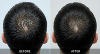 Male pattern baldness treatment comparison showing crown area hair loss improvement and regrowth results for medical and cosmetic procedures.