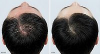 Male pattern baldness treatment before and after comparison showing hair restoration results on crown area of middle-aged Caucasian man's scalp.