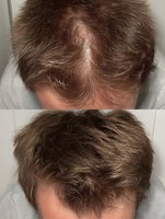 Before and after comparison of hair restoration treatment showing significant improvement in hair density and coverage on scalp with brown hair.