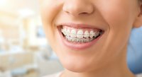 Close-up of young woman's smile showing metal braces on teeth in dental office. Orthodontic treatment and oral health care concept.