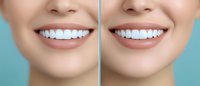Before and after comparison of teeth whitening results showing bright white smile and healthy lips against turquoise background for dental care advertising.