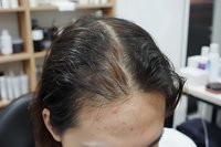 Close-up view of Asian woman's scalp showing hair thinning and receding hairline pattern, demonstrating female pattern hair loss condition in clinical setting.