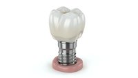 Dental implant with crown and abutment on white background isolated for medical education and dentistry presentations.