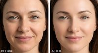 Before and after comparison showing middle-aged Caucasian woman with skin rejuvenation treatment results, demonstrating wrinkle reduction and smoother complexion.