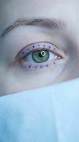 Close-up of green eye with blue surgical markings around eyelid for blepharoplasty or cosmetic surgery procedure preparation on patient face.