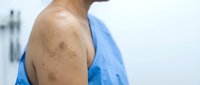 Young Caucasian man with vitiligo skin condition showing depigmented patches on shoulder and arm, medical dermatology concept for healthcare awareness.