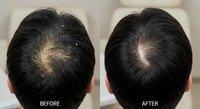 Male hair loss treatment before and after comparison showing crown area improvement with reduced balding and increased hair density for medical advertising.