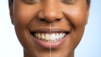 African American woman showing teeth whitening transformation with before and after comparison of dental treatment results on light background.