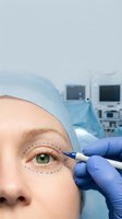 Surgeon marking dotted lines around female patient eye for blepharoplasty eyelid surgery in modern operating room with medical equipment.