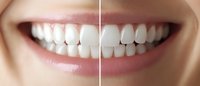 Before and after comparison of teeth whitening treatment showing dramatic improvement in dental color from yellow to bright white healthy smile.