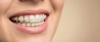 Woman with ceramic braces smiling showing orthodontic treatment and dental care for teeth alignment and oral health improvement.