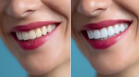 Before and after comparison showing teeth whitening results with bright smile and red lipstick against blue background, demonstrating dental cosmetic procedure outcome.
