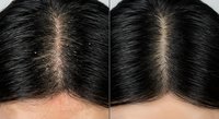 Hair loss treatment before and after comparison showing scalp with thinning hair transformed to fuller coverage for medical and cosmetic applications.