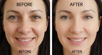 Before and after comparison showing facial skin improvement transformation with reduced wrinkles and enhanced complexion for beauty treatment results.