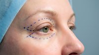 Mature woman with surgical markings around eye area for cosmetic blepharoplasty procedure planning in medical setting.