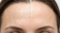 Young woman forehead showing before and after skincare treatment results with clear skin improvement and blemish reduction for cosmetic dermatology concepts.