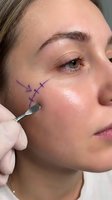 Young Caucasian woman receiving cosmetic surgery consultation with purple surgical markings on face for aesthetic procedure planning and medical treatment.