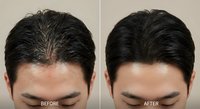 Male hair loss treatment before and after comparison showing dramatic improvement in hair density and coverage on crown area.