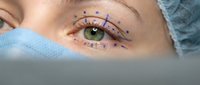 Woman with green eyes marked for cosmetic eyelid surgery procedure. Medical consultation for blepharoplasty operation with surgical guidelines drawn on skin.