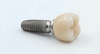 Dental implant with ceramic crown isolated on white background for medical and healthcare presentations.
