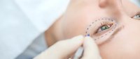 Plastic surgeon marking facial surgery lines around female patient eye area for cosmetic blepharoplasty procedure in medical clinic setting.
