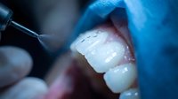 Dental examination with probe checking tooth enamel during oral health checkup procedure in modern clinic setting for preventive care treatment.