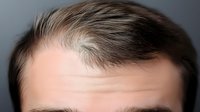 Young Caucasian man with receding hairline showing early male pattern baldness and forehead wrinkles in close-up portrait for hair loss treatment concepts.
