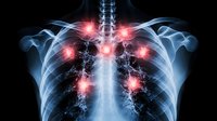 Chest x-ray visualization showing multiple red glowing areas representing lung inflammation and infection points against dark background with blue skeletal structure.