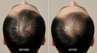 Male pattern baldness treatment comparison showing hair restoration results on Caucasian man's scalp from above before and after procedure.