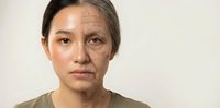 Asian woman with facial mapping lines for cosmetic surgery consultation and aesthetic treatment planning procedures.