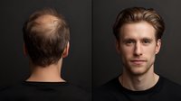 Comparison of male pattern baldness and full hair restoration, showing dramatic before and after results against dark background.