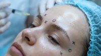 Young woman with surgical markings on face preparing for cosmetic procedure in medical clinic with surgeon hands in background.