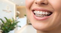 Close-up of young woman smiling with metal braces on teeth in modern dental office. Orthodontic treatment and oral health care concept.