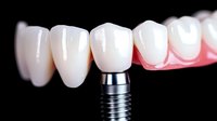 Dental implant with crown and natural-looking teeth in jaw showing modern dentistry restoration and prosthetic technology for oral health care.